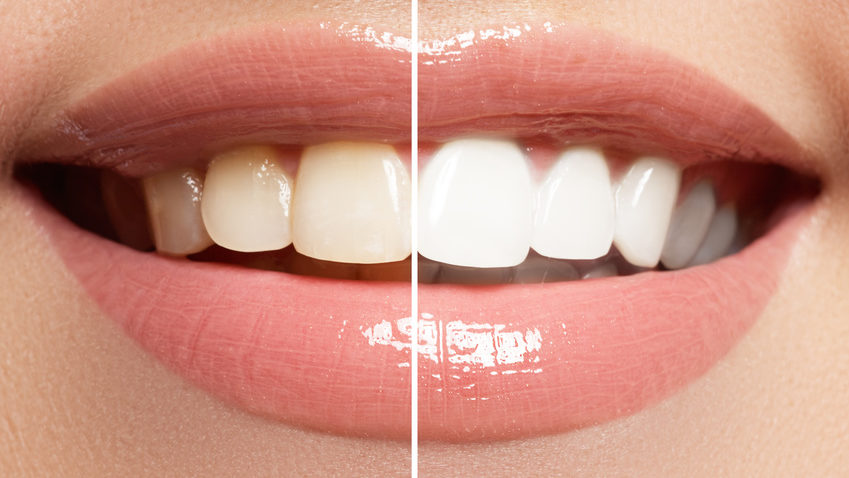 Schöne weiße Zähne